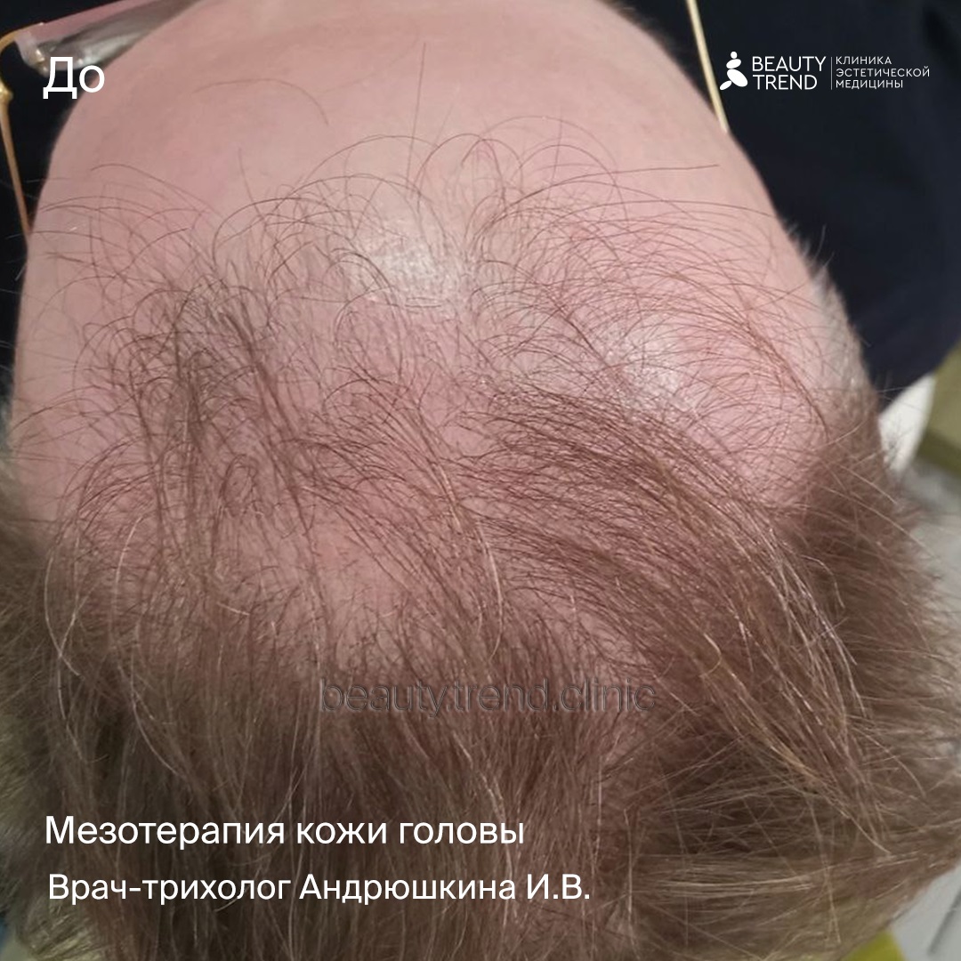Мезотерапия для укрепления волос, 2А - до